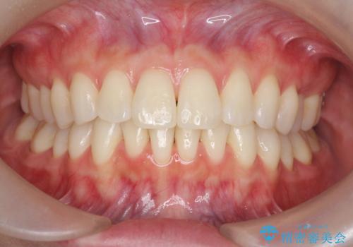 昔ワイヤー矯正をして後戻りした 軽度のがたつき モニター矯正の治療後