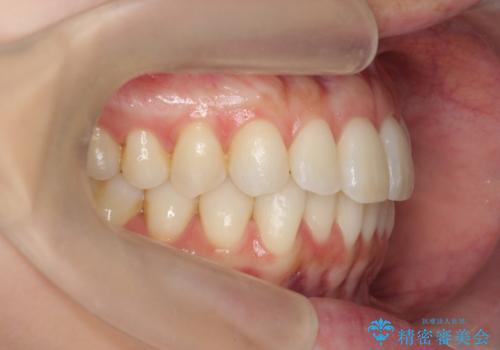 昔ワイヤー矯正をして後戻りした 軽度のがたつき モニター矯正の治療後