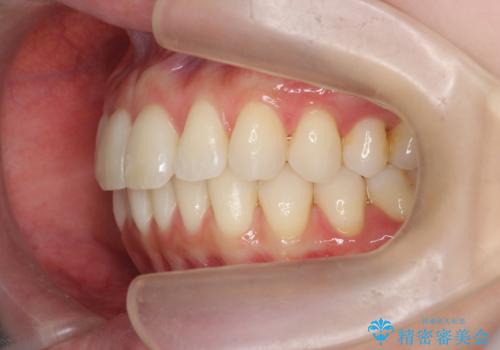 昔ワイヤー矯正をして後戻りした 軽度のがたつき モニター矯正の治療後