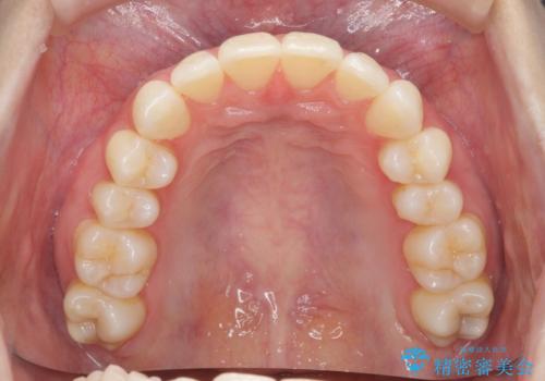 昔ワイヤー矯正をして後戻りした 軽度のがたつき モニター矯正の治療後