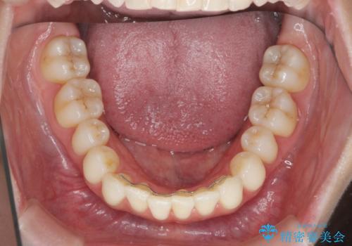 昔ワイヤー矯正をして後戻りした 軽度のがたつき モニター矯正の治療後