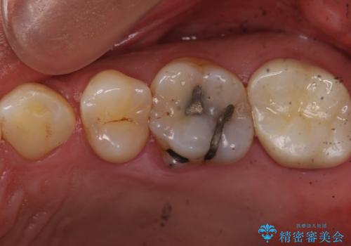 ものが詰まるから、治療してほしい セラミック治療