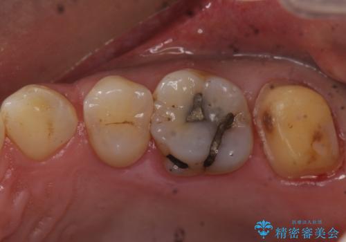 ものが詰まるから、治療してほしい セラミック治療の治療中