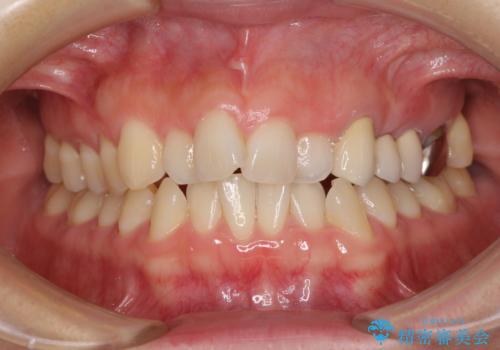 捻れた前歯と銀歯のブリッジを治したい ワイヤー矯正とオールセラミックブリッジの治療前