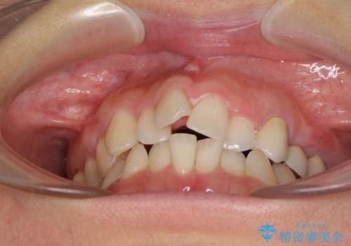 捻れた前歯と銀歯のブリッジを治したい ワイヤー矯正とオールセラミックブリッジの治療前