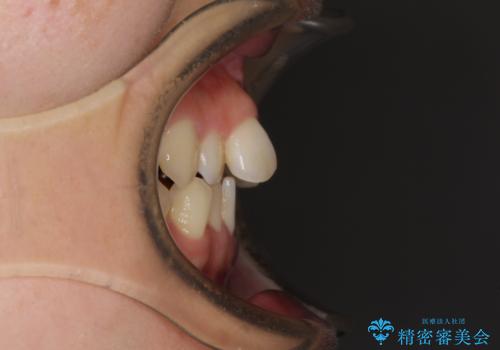 捻れた前歯と銀歯のブリッジを治したい ワイヤー矯正とオールセラミックブリッジの治療前