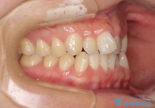 捻れた前歯と銀歯のブリッジを治したい ワイヤー矯正とオールセラミックブリッジの治療前