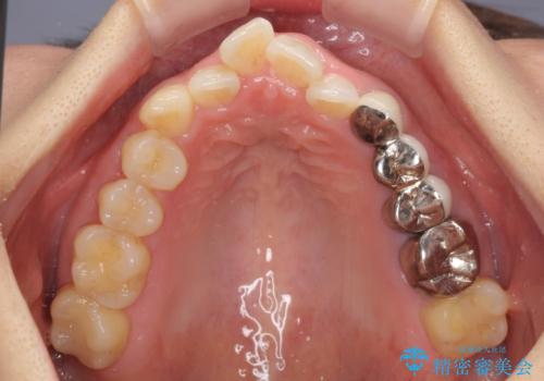 捻れた前歯と銀歯のブリッジを治したい ワイヤー矯正とオールセラミックブリッジの治療前