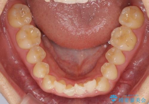 捻れた前歯と銀歯のブリッジを治したい ワイヤー矯正とオールセラミックブリッジの治療前