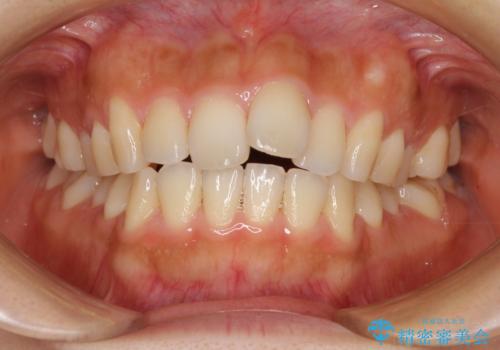 カリエールディスタライザーを併用した、咬み合わせ改善のインビザライン矯正の症例 治療前