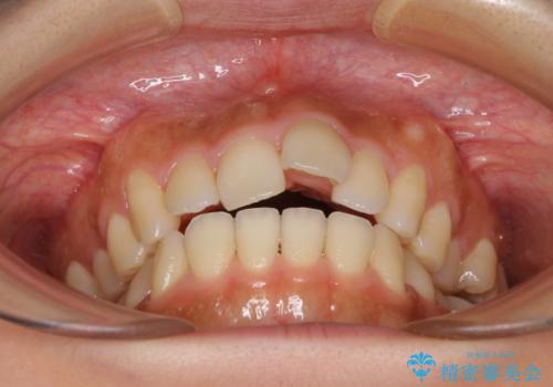 カリエールディスタライザーを併用した、咬み合わせ改善のインビザライン矯正の治療前