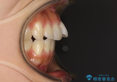 カリエールディスタライザーを併用した、咬み合わせ改善のインビザライン矯正の治療前