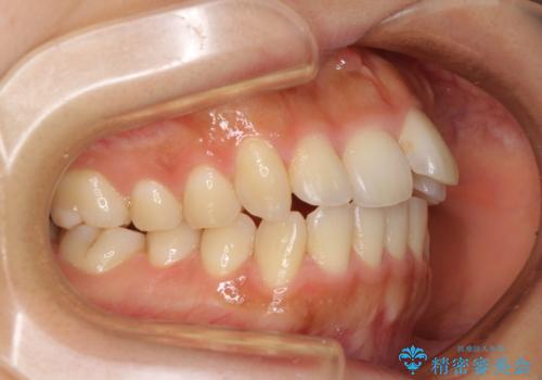 カリエールディスタライザーを併用した、咬み合わせ改善のインビザライン矯正の治療前