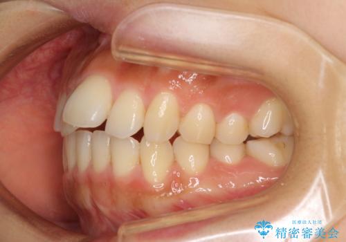カリエールディスタライザーを併用した、咬み合わせ改善のインビザライン矯正の治療前