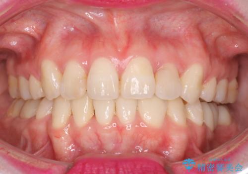 八重歯のワイヤーによる抜歯矯正　 矯正治療と並行してセラミック治療もの症例 治療後