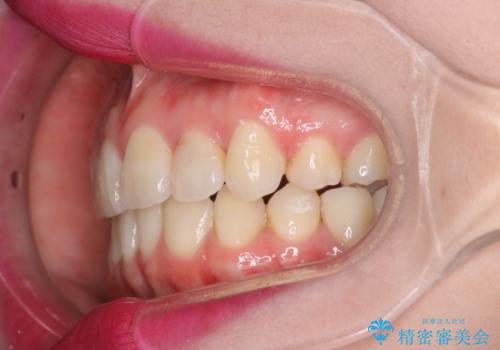 八重歯のワイヤーによる抜歯矯正　 矯正治療と並行してセラミック治療もの治療後