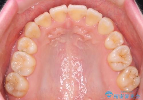 八重歯のワイヤーによる抜歯矯正　 矯正治療と並行してセラミック治療もの治療後