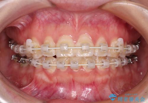 【モニター】前歯のデコボコを目立たないワイヤー装置で短期間矯正治療の治療中