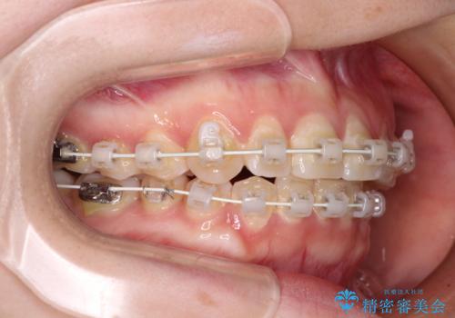 【モニター】前歯のデコボコを目立たないワイヤー装置で短期間矯正治療の治療中