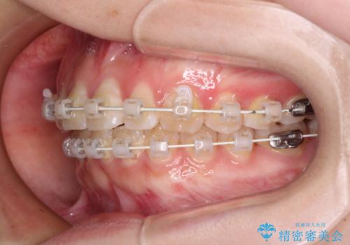 【モニター】前歯のデコボコを目立たないワイヤー装置で短期間矯正治療の治療中