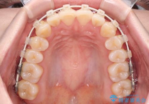 【モニター】前歯のデコボコを目立たないワイヤー装置で短期間矯正治療の治療中