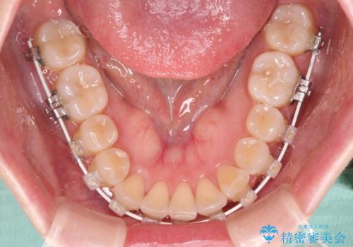 【モニター】前歯のデコボコを目立たないワイヤー装置で短期間矯正治療の治療中