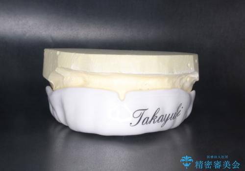 ラグビー用のマウスピースを作りたい スポーツ用マウスピースの症例 治療前