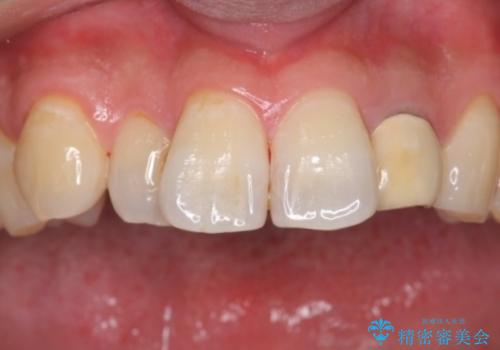 結婚式までに歯を白くの治療前