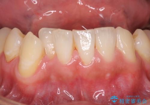 結婚式までに歯を白くの治療前