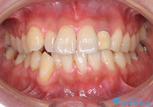 結婚式までに歯を白くの治療前