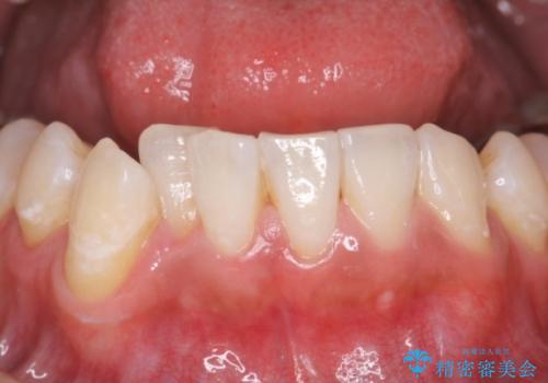 結婚式までに歯を白くの治療後