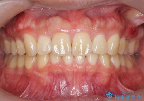 出っ歯を治したい 深いかみあわせ インビザラインで治療の症例 治療後