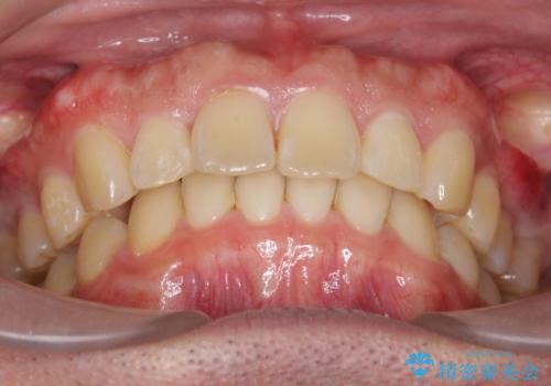 出っ歯を治したい 深いかみあわせ インビザラインで治療の治療後