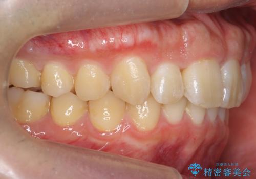 出っ歯を治したい 深いかみあわせ インビザラインで治療の治療後