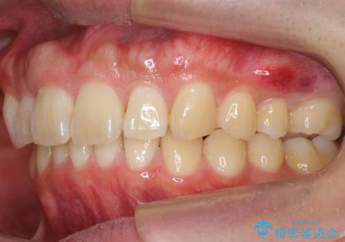 出っ歯を治したい 深いかみあわせ インビザラインで治療の治療後