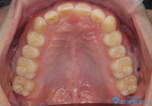 出っ歯を治したい 深いかみあわせ インビザラインで治療の治療後