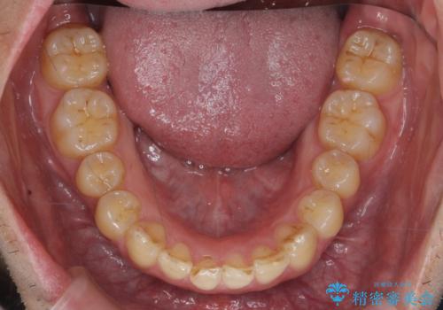 出っ歯を治したい 深いかみあわせ インビザラインで治療の治療後