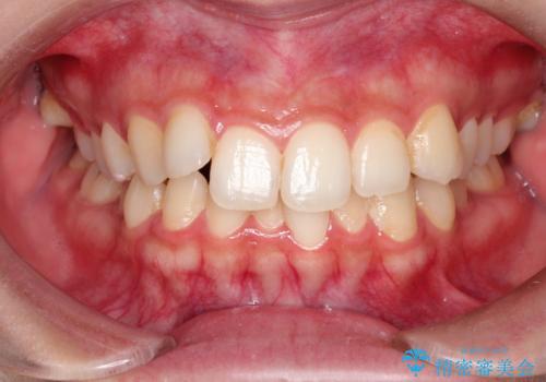前歯のがたがた気になる　インビザラインによる矯正治療の症例 治療前