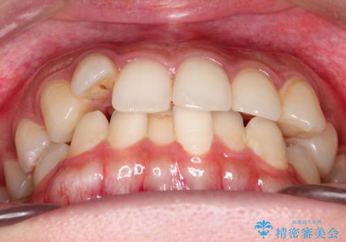 前歯のがたがた気になる　インビザラインによる矯正治療の治療前