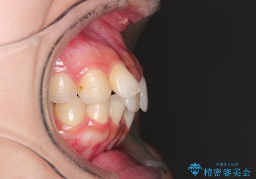 前歯のがたがた気になる インビザラインによる矯正治療の治療前