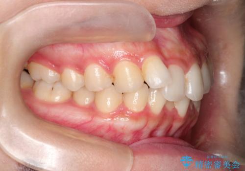 前歯のがたがた気になる インビザラインによる矯正治療の治療前