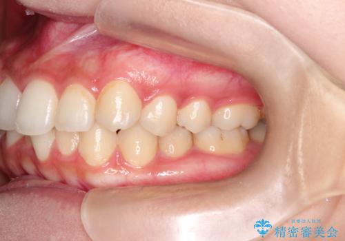 前歯のがたがた気になる　インビザラインによる矯正治療の治療前