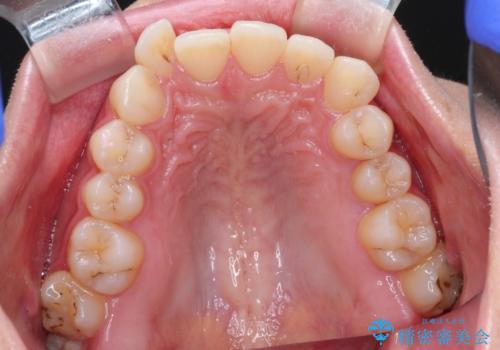 前歯のがたがた気になる インビザラインによる矯正治療の治療前