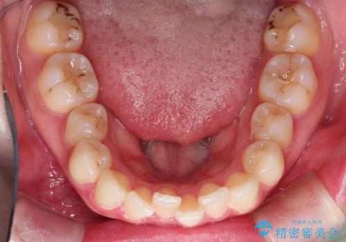 前歯のがたがた気になる インビザラインによる矯正治療の治療前