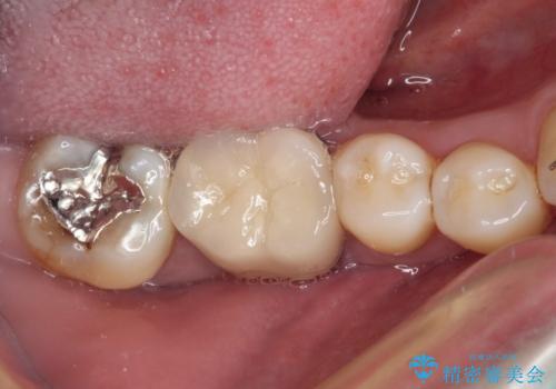 奥歯に物が挟まる　セラミックインレーによる虫歯治療の症例 治療前