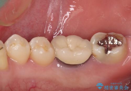 奥歯に物が挟まる セラミックインレーによる虫歯治療の治療前