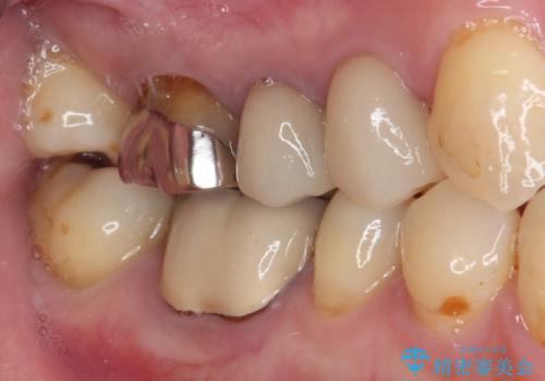 奥歯に物が挟まる セラミックインレーによる虫歯治療の治療前