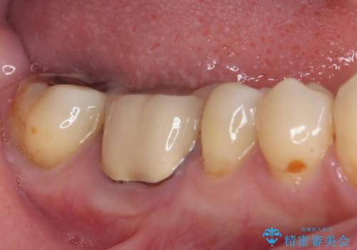 奥歯に物が挟まる セラミックインレーによる虫歯治療の治療前