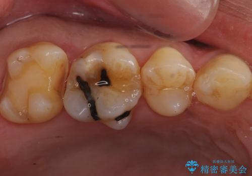 昔治療した銀歯を綺麗なセラミックに変えたい セラミックインレーの治療中