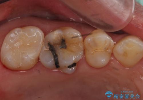 昔治療した銀歯を綺麗なセラミックに変えたい セラミックインレーの治療後